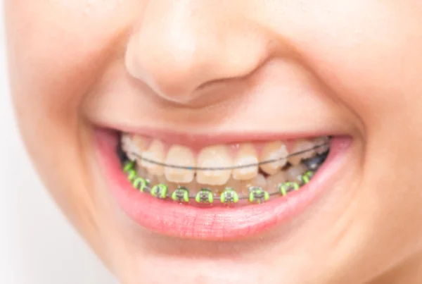 Braces