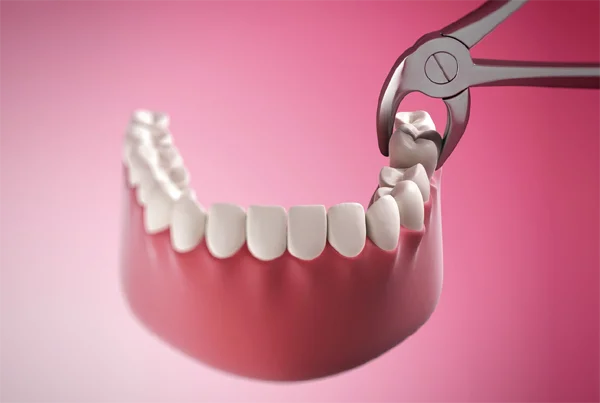 Tooth Extraction