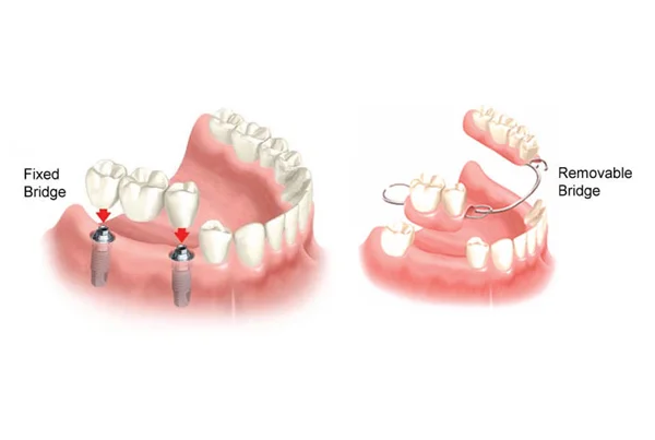 Fixed Partial Denture